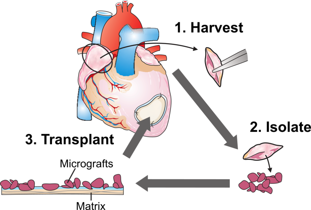 Graphics of the coronary artery bypass grafting (CABG) surgery.